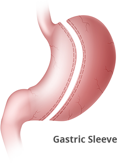 Gastric Sleeve Illustration