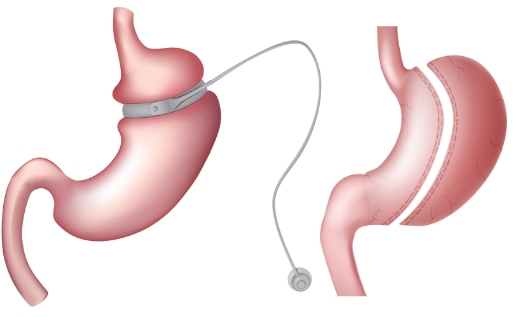 Gastric Sleeve Illustration