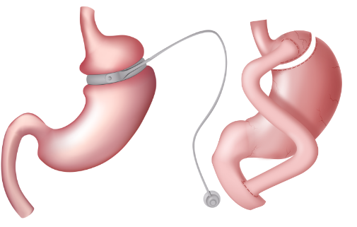 Gastric Sleeve Illustration