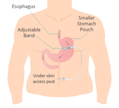 Gastric Sleeve Illustration